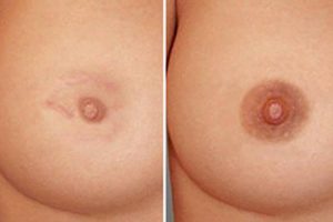 Areolapigmenation